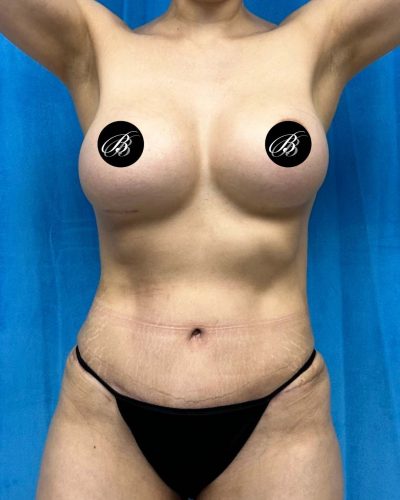 Mini tummy tuck after photo, case 1560090, actual patient of Dr. Anh-Tuan Truong in Chicago