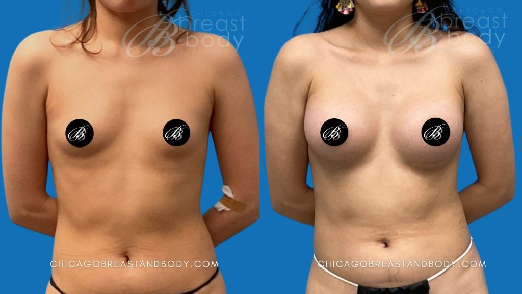 Chicago Breast Augmentation 300cc Before After by Dr. Kevin Lin 3mo 2002544