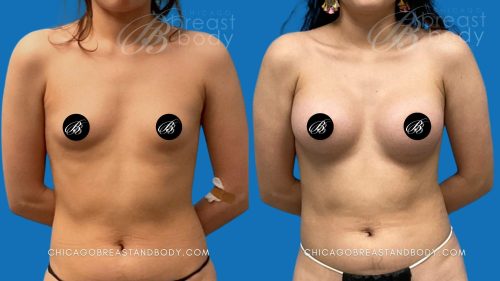 Chicago Breast Augmentation 300Cc Before After By Dr. Kevin Lin 3Mo 2002544