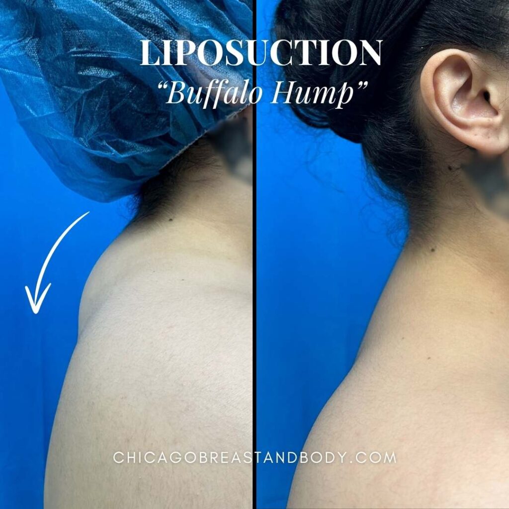 2183069 Buffalo Hump Liposuction Before And After By Dr. Anh Tuan Truong Chicago Breast And Body