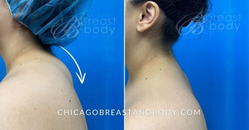 before and after photo of buffalo hump liposuction