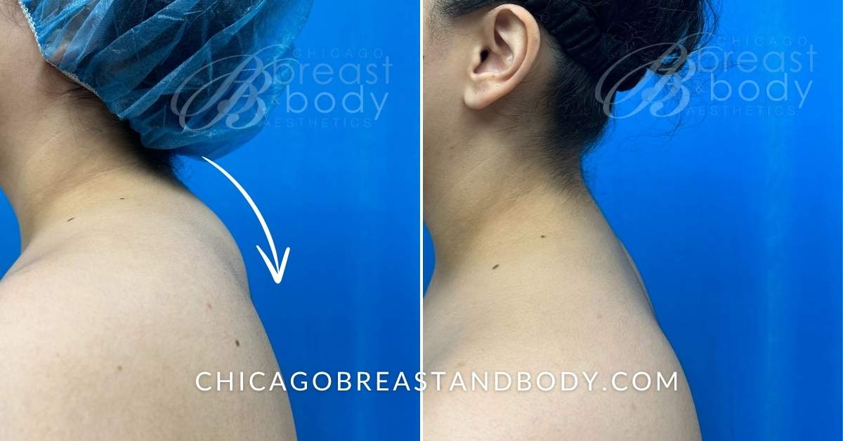 Before And After Photo Of Buffalo Hump Liposuction