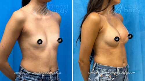 2320976 Breast Implant 250Cc High Profile 3 Months By Dr Kevin Lin Chicago