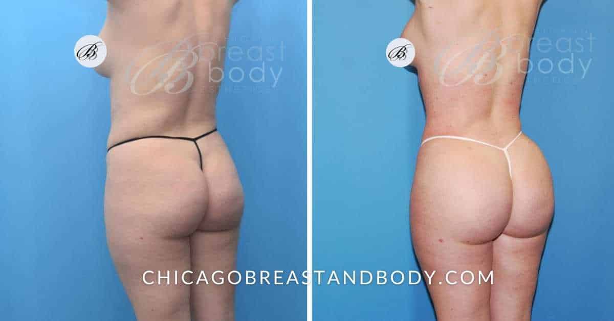 Before and After BBL & Hip Augmentation by Dr. Anh Tuan Truong 2 months 1511908