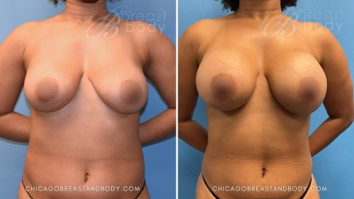 Breast Augmentation (335Cc High Profile Extra) By Dr. Kevin Lin Chicago Breast And Body 3 Months 1580172