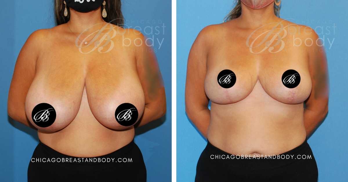 Chicago Breast Reduction Before After By Dr. Anh-Tuan Truong Chicago Breast And Body After 9 Months 1663037