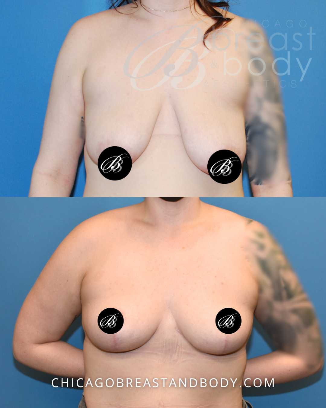 Chicago Breast Lift Mastopexy Before After by Dr. Anh Tuan Truong after 6 months -1677548