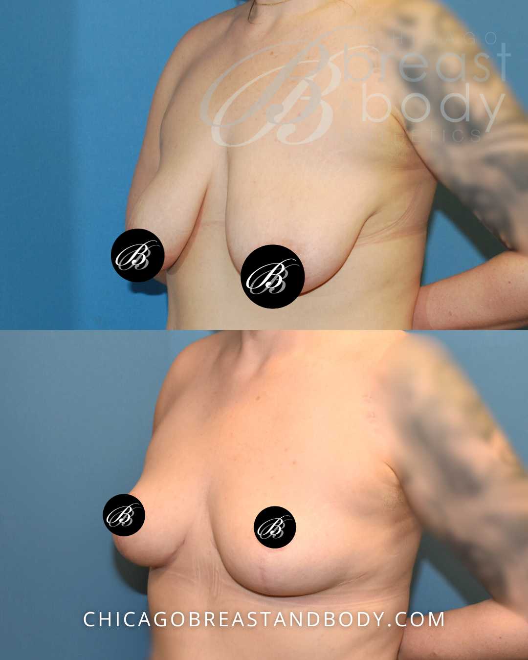 Chicago Breast Lift Mastopexy Before After by Dr. Anh Tuan Truong after 6 months -1677548
