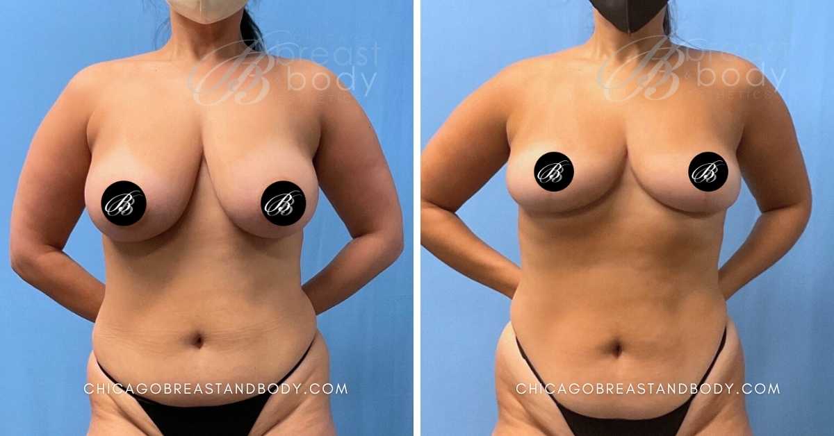 Chicago Breast Reduction Before After By Dr. Kevin Lin Chicago Breast And Body After 3 Months 1846191
