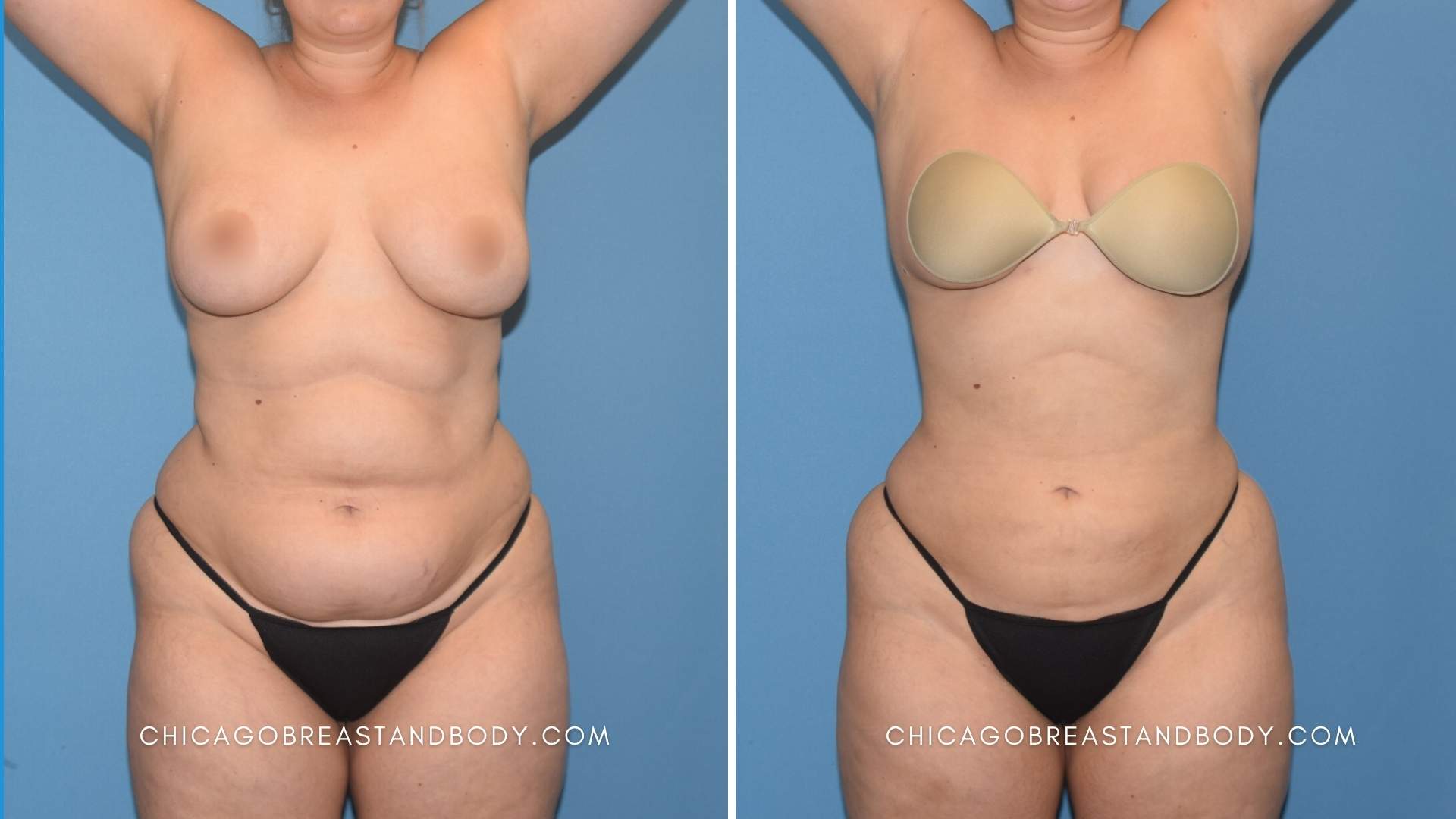 Renuvion skin tightening with liposuction before and after by Dr. Truong at Chicago Breast and Body