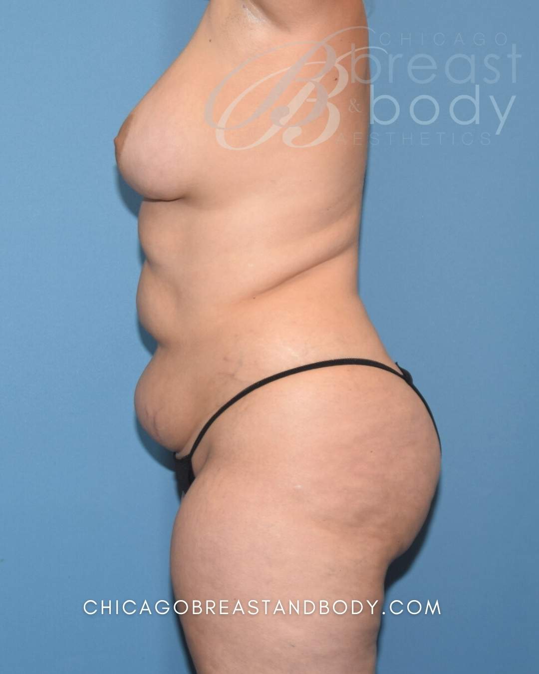 Stomach liposuction with Renuvion before after photo by Dr. Anh Tuan Truong Chicago Breast and Body 1910496