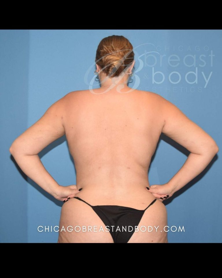 After Lipo 360, back view, 3 months after surgery, case 1910496, patient of Dr. Anh-Tuan Truong