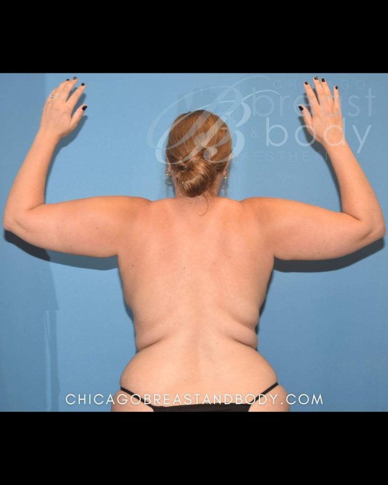 Before ArmSculpt arm liposuction with Renuvion photo, case 19104960, patient of Dr. Anh-Tuan Truong, back view, arms raised