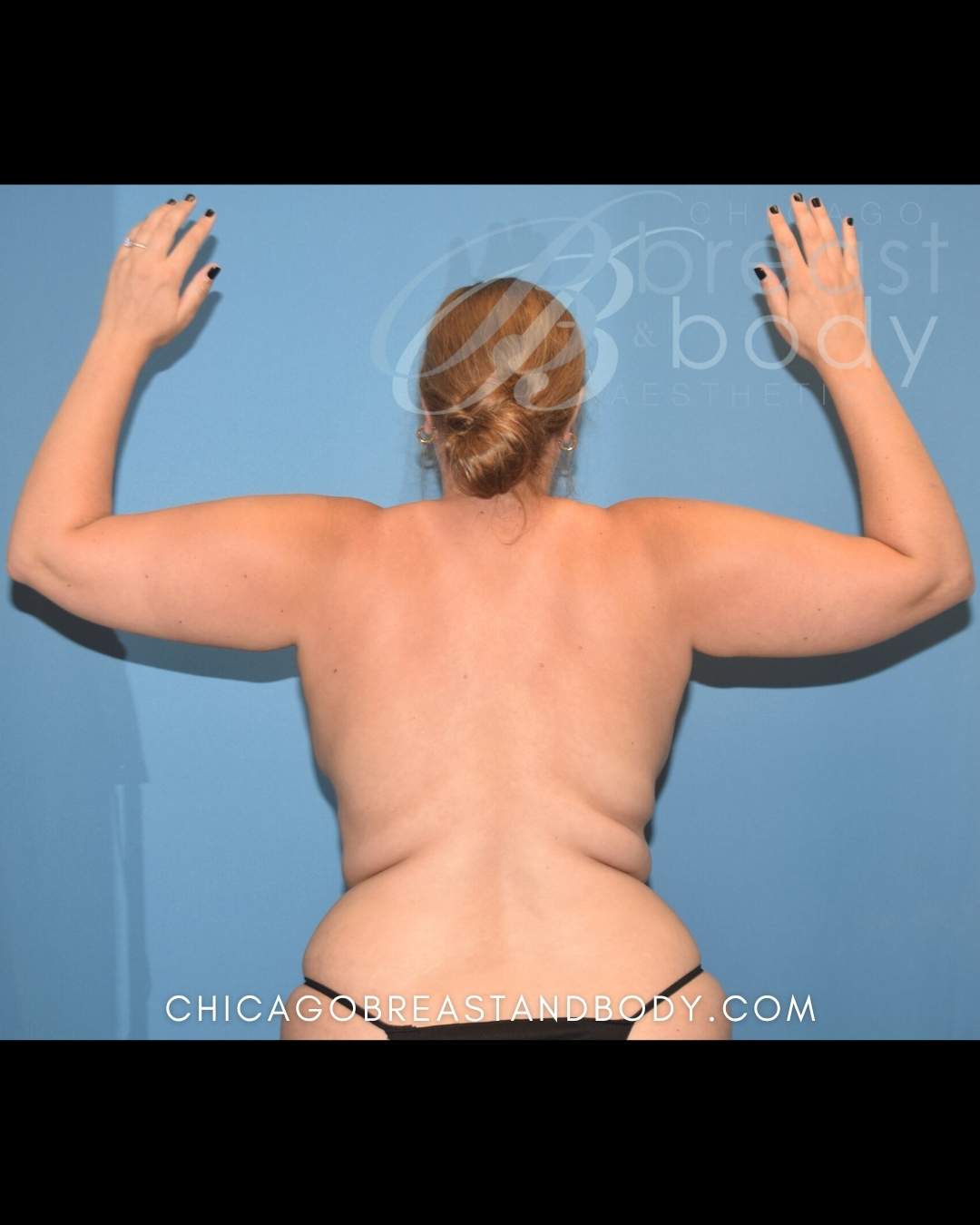 Arm liposuction with Renuvion before after photo by Dr. Anh Tuan Truong Chicago Breast and Body 1910496
