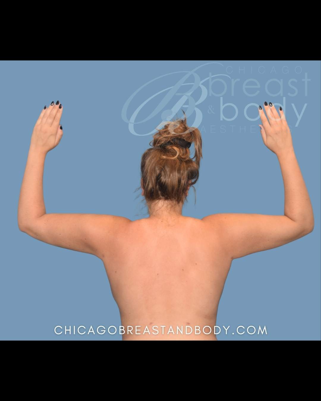 Arm liposuction with Renuvion before after photo by Dr. Anh Tuan Truong Chicago Breast and Body 1910496