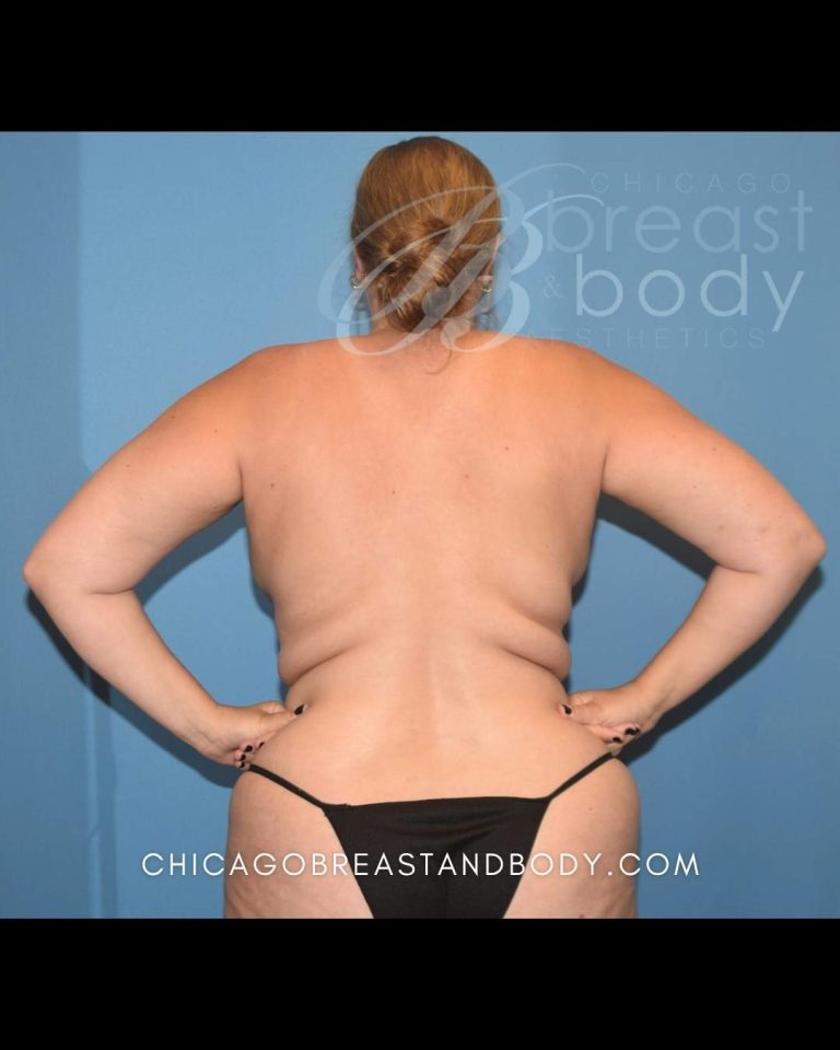 Before Lipo 360, back view, case 1910496, patient of Dr. Anh-Tuan Truong