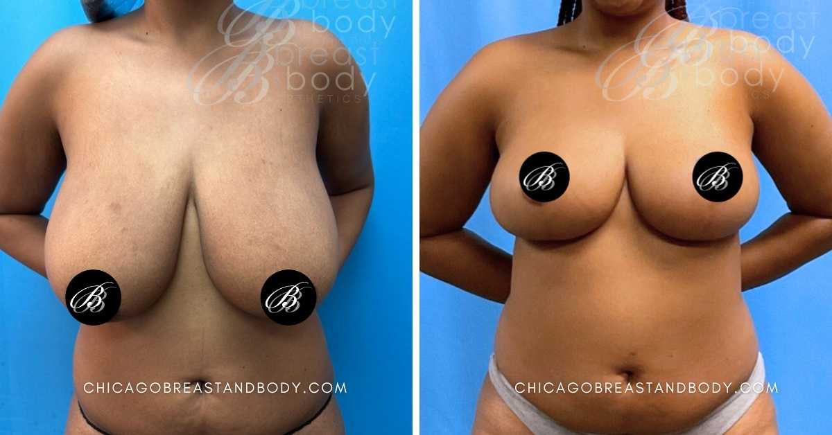 Chicago Breast Reduction Before After By Dr. Kevin Lin Chicago Breast And Body After 3 Months 1990161