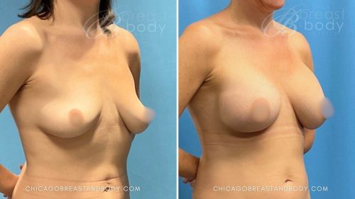400Cc Breast Augmentation By Dr. Kevin Lin Chicago Breast And Body 3 Months - 1997377