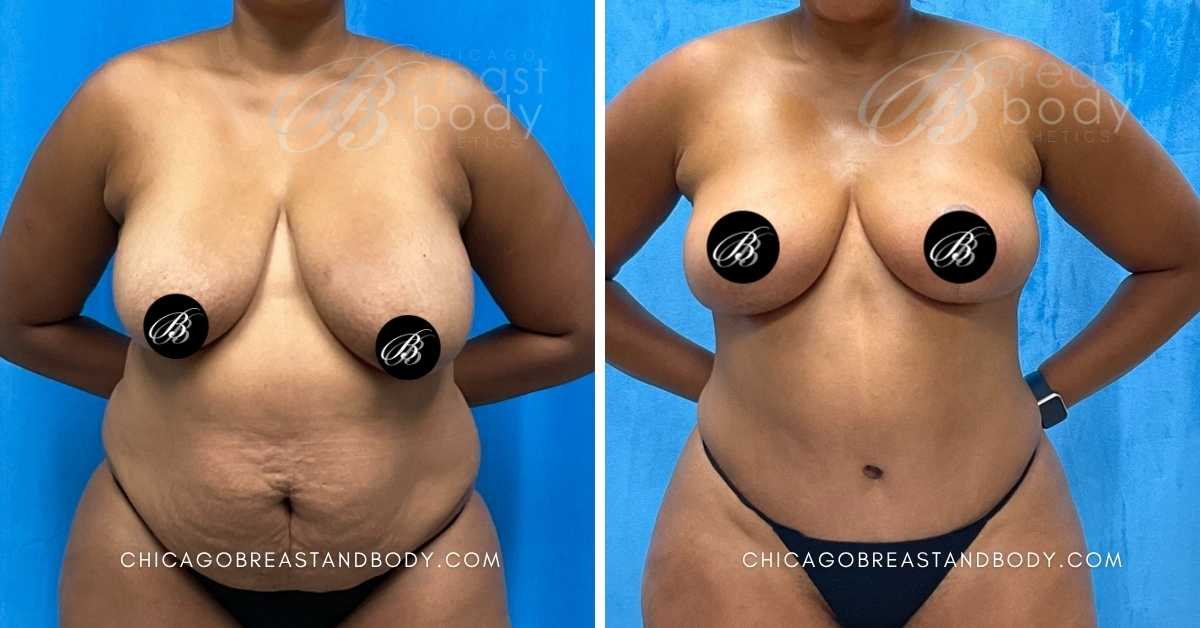 Chicago Breast Reduction Before After By Dr. Kevin Lin Chicago Breast And Body After 3 Months 2190579