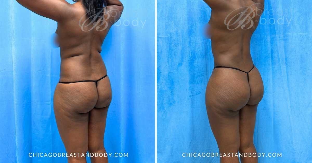 Brazilian Butt Lift Lipo 360 Before After by Dr. Anh Tuan Truong Chicago Breast & Body 3 months post 2297957
