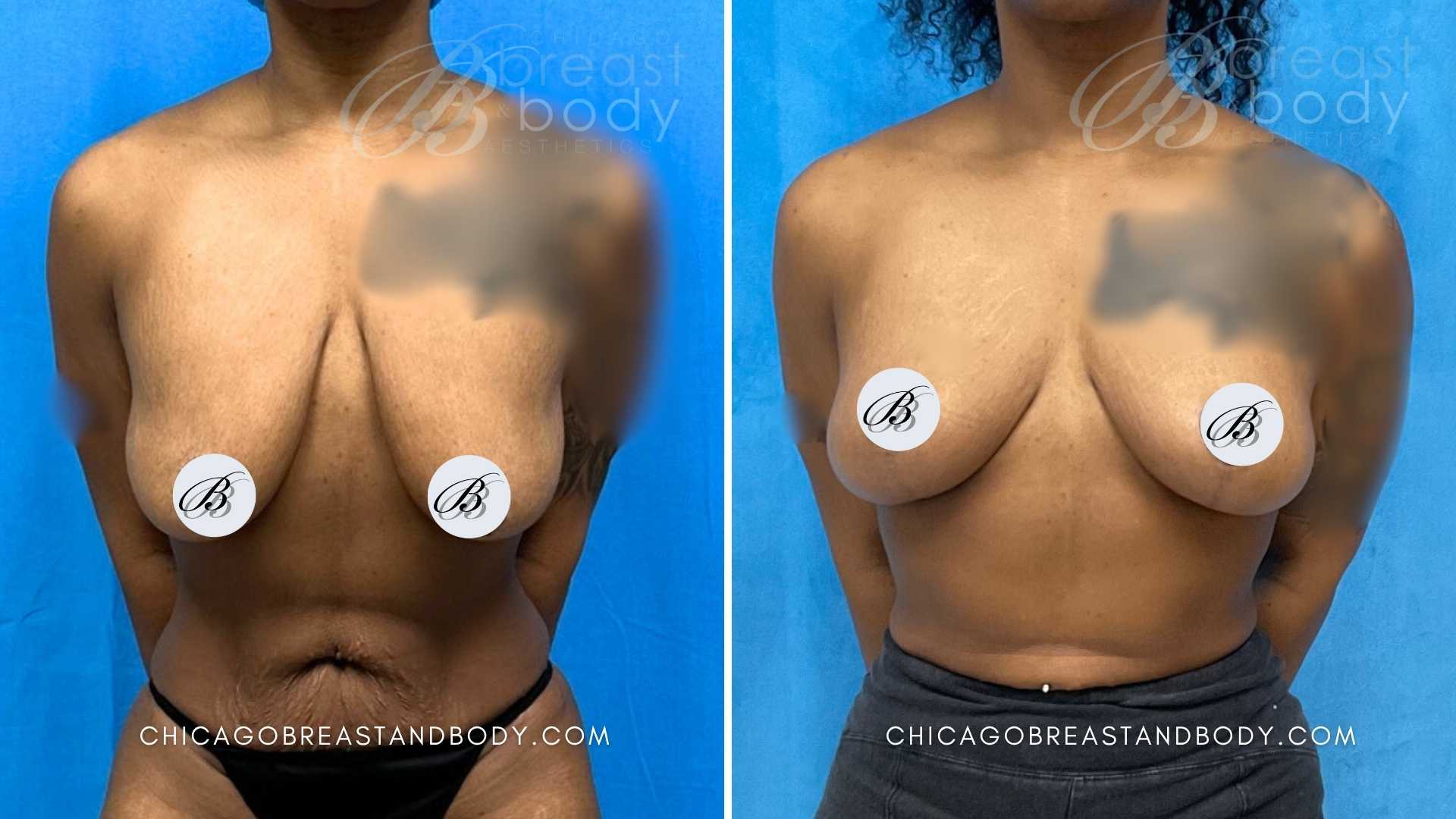 Breast Lift Mastopexy Before After 3 months by Dr Kevin Lin Chicago Breast and Body 2323731