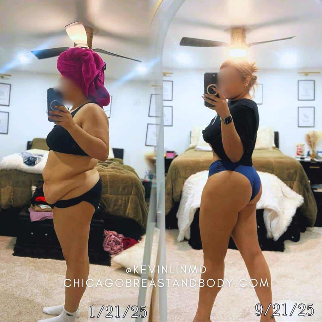 Patient Selfie after Lipo 360 BBL Tummy Tuck by Dr. Kevin Lin Chicago