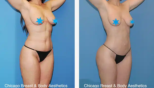 Hip-Widening-Surgery-Before-After-Case-747-Chicago-Breast-And-Body1-Copia