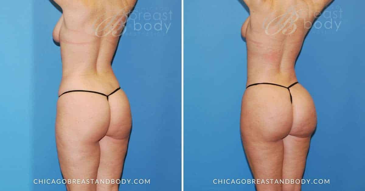 Before and after results at Chicago Breast & Body