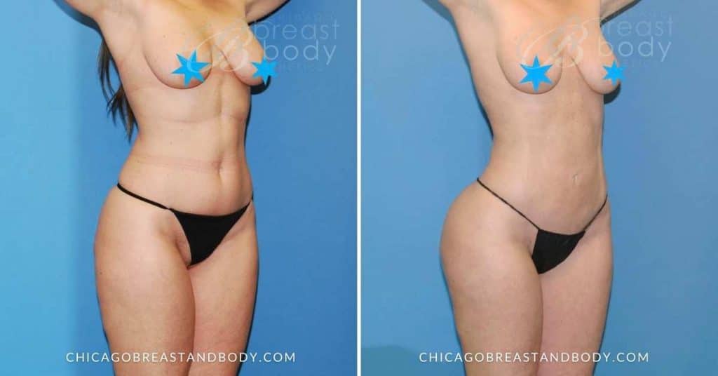 Liposuction With Renuvion Before After By Dr. Anh Tuan Truong Chicago Breast &Amp; Body 2 Monthnths Post 1522320