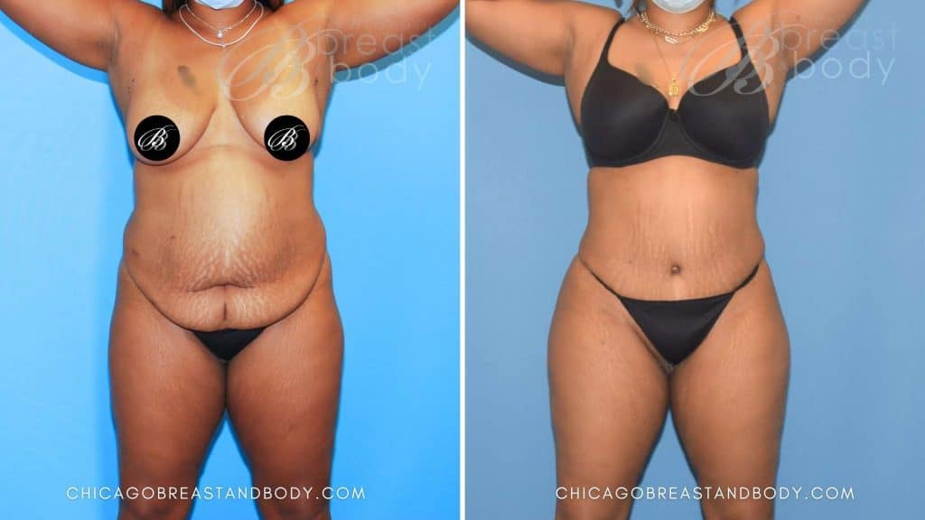 How Much Does A Tummy Tuck Cost In Chicago? | Chicago Breast And Body Aesthetics