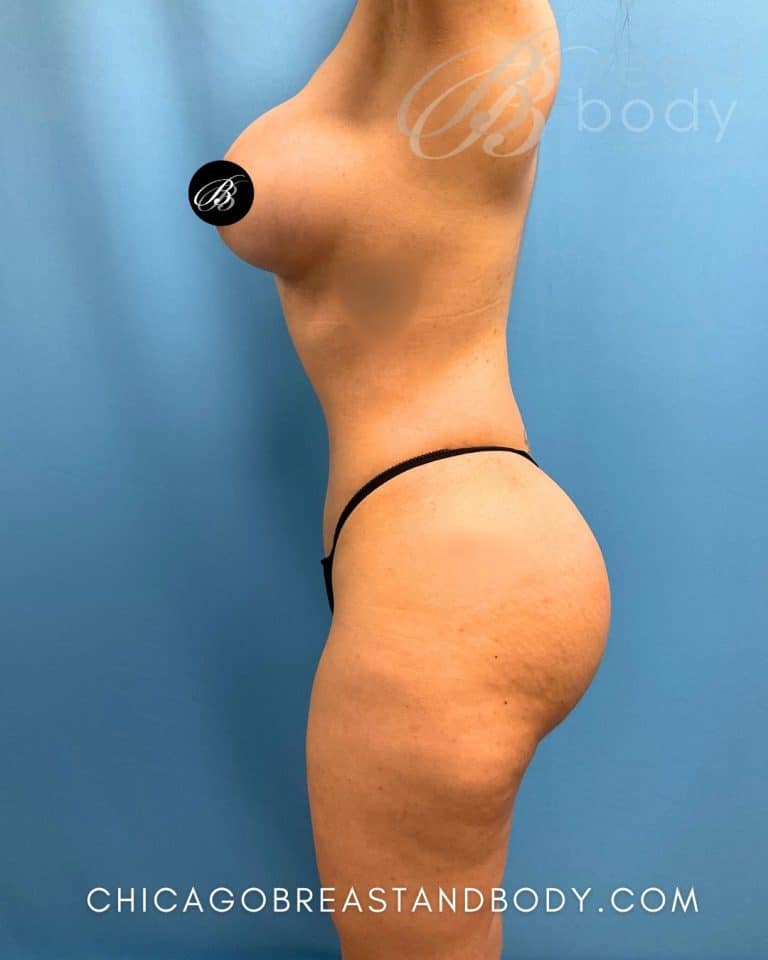 After Lipo 360, side view, 3 months after surgery, case 1627208, patient of Dr. Kevin Lin