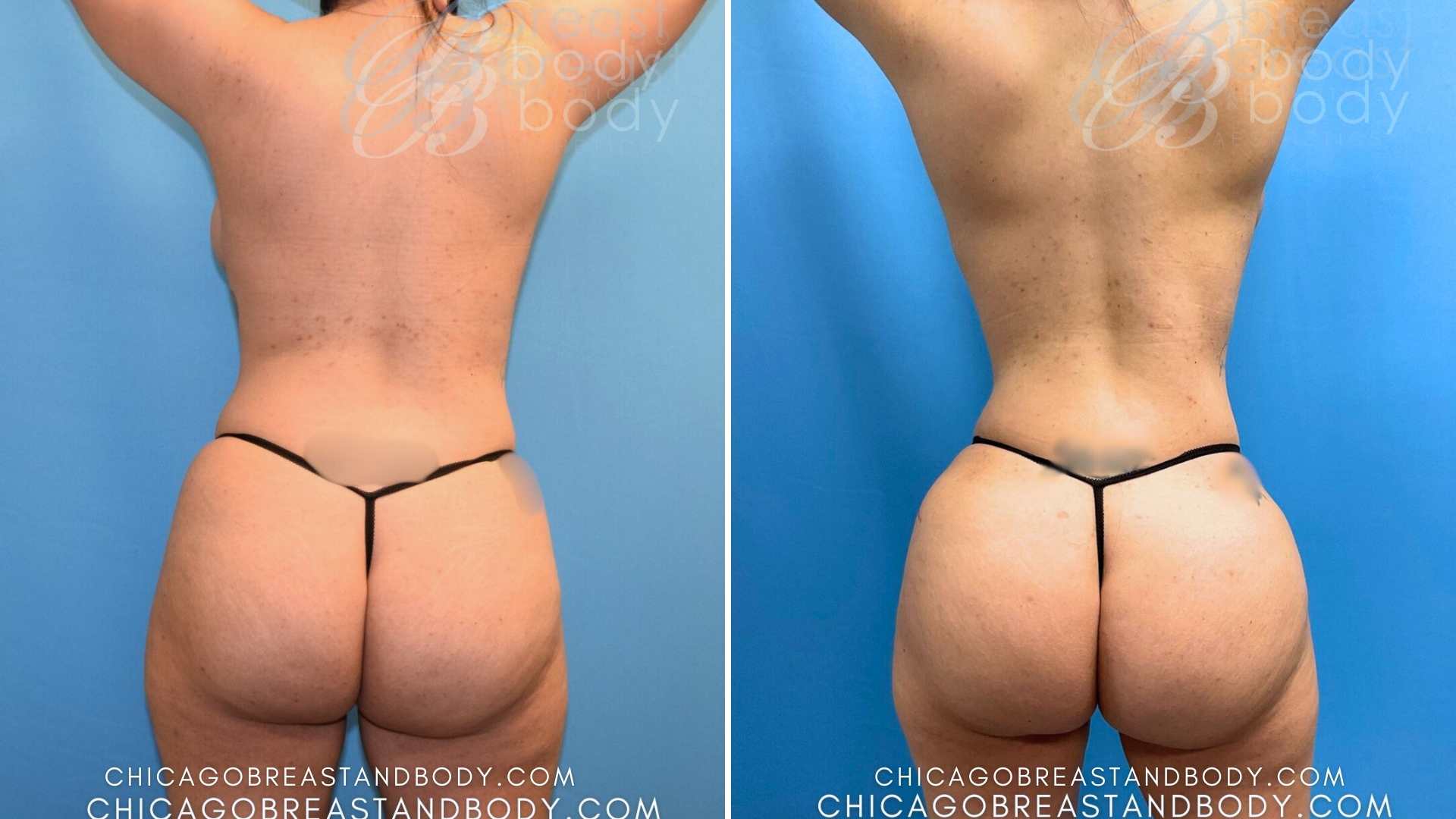 Lipo 360 Before After Photos By Dr. Pey-Yi Kevin Lin Chicago Breast &Amp; Body Aesthetics 1627208
