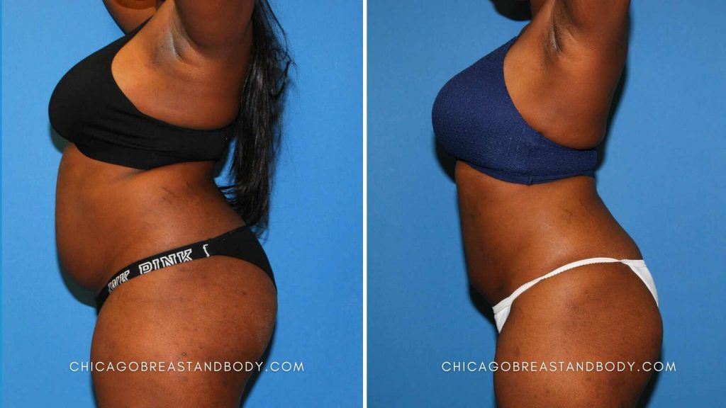 Stomach Liposuction Before After by Dr. Anh Tuan Truong Chicago 405