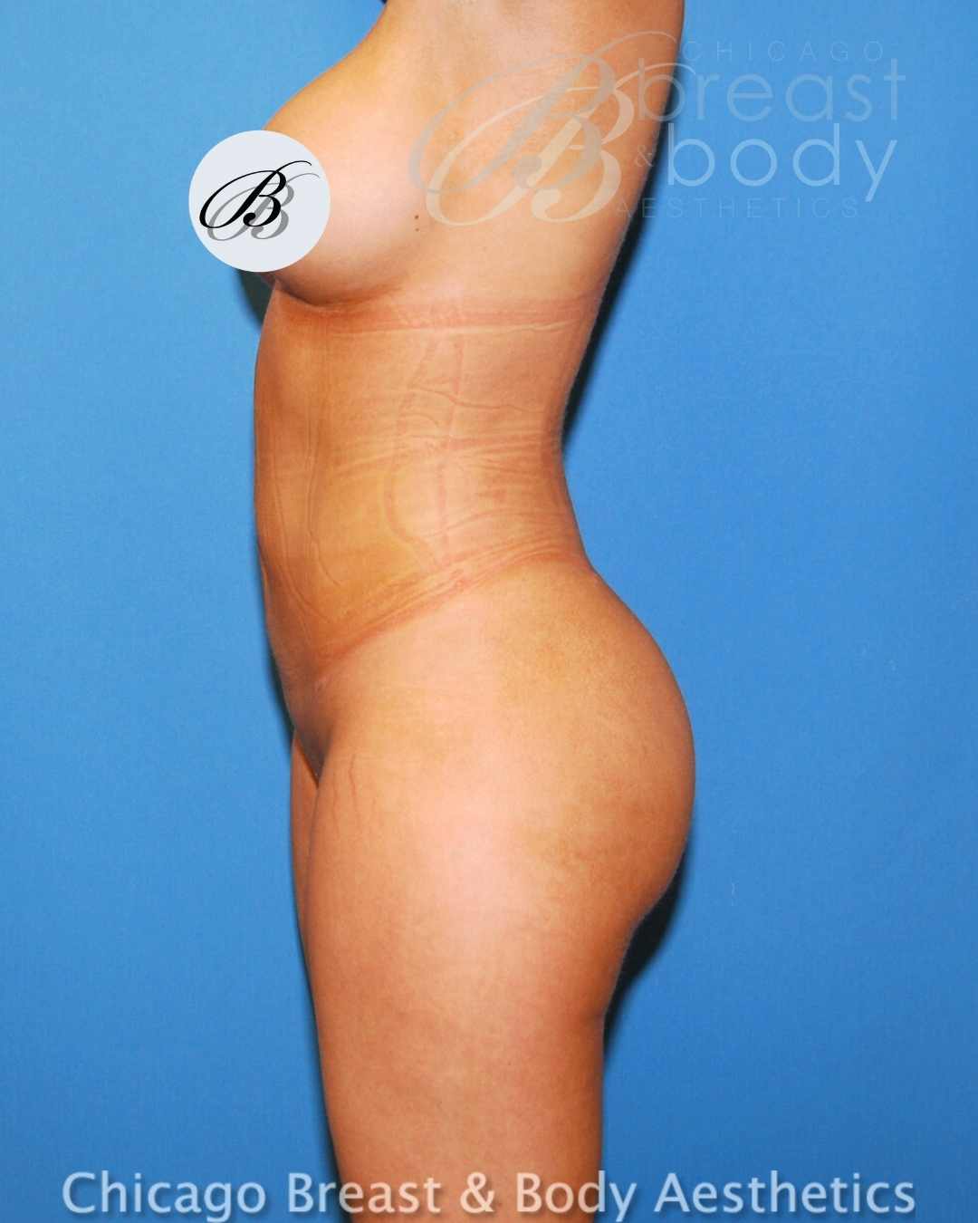 Lipo 360, Skinny BBL after photo 2, case #441, Dr. Anh-Tuan Truong, Chicago Breast & Body