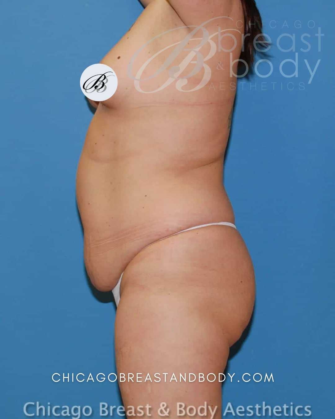 Laser Liposuction Before After by Dr. Anh Tuan Truong Chicago 497