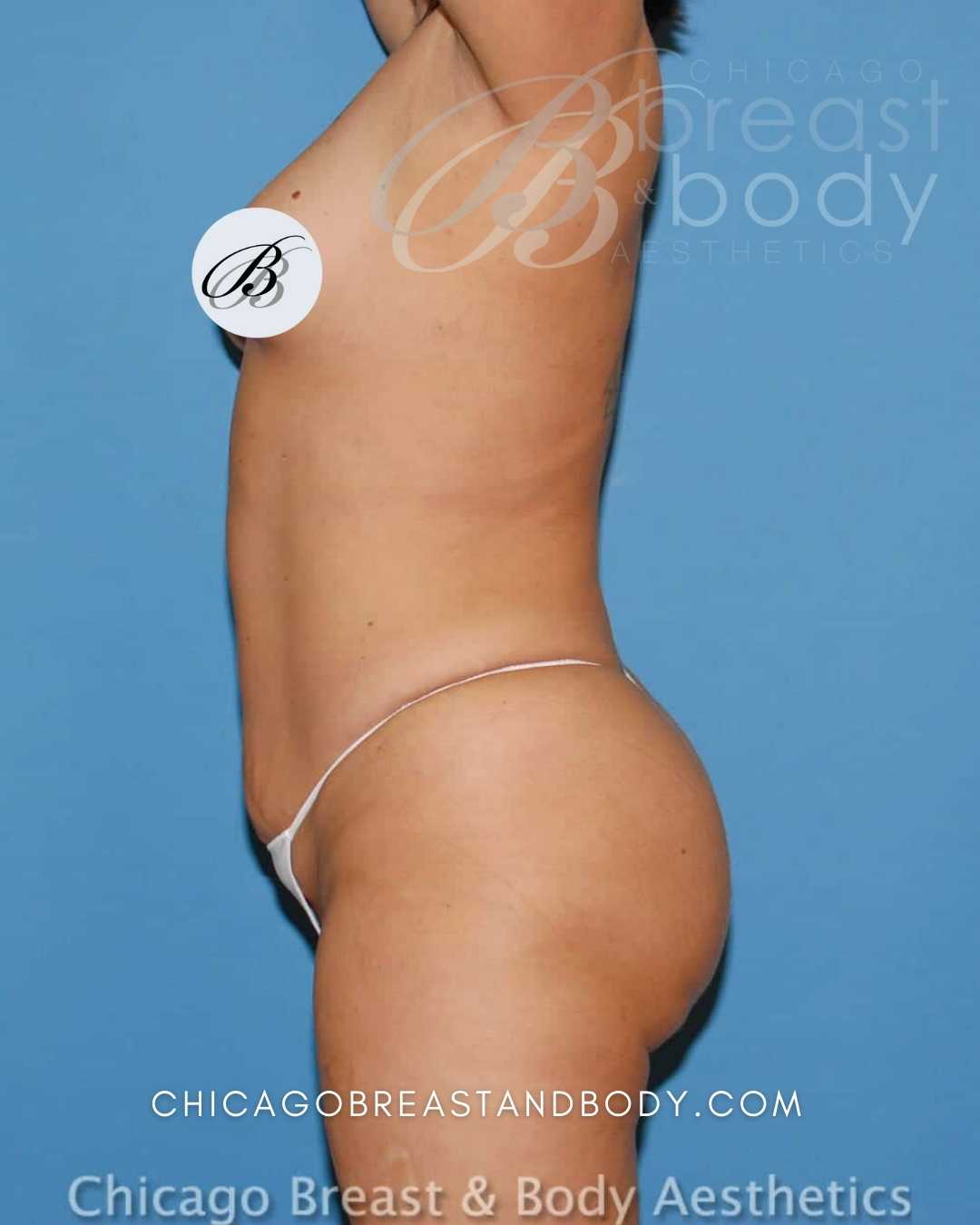 Laser Liposuction Before After by Dr. Anh Tuan Truong Chicago 497