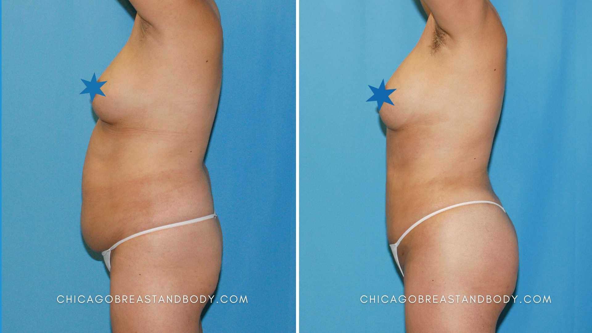 Laser liposuction Smart Lipo before and after results by Dr. Truong at Chicago Breast and Body