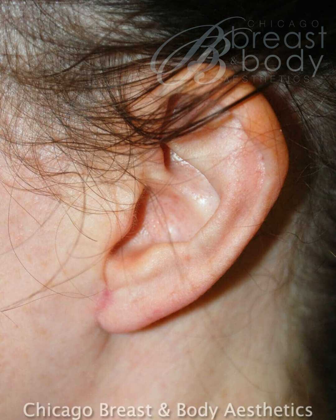 Earlobe Repair after photo 2, case #275, Dr. Anh-Tuan Truong, Chicago Breast & Body