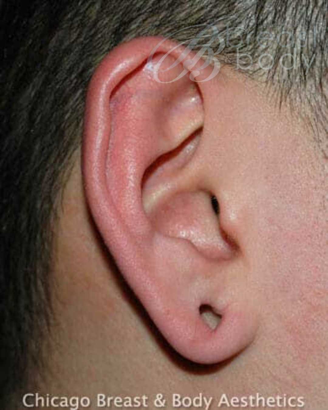 Earlobe repair surgery before after photo by Dr. Truong Chicago Breast & Body Aesthetics #52