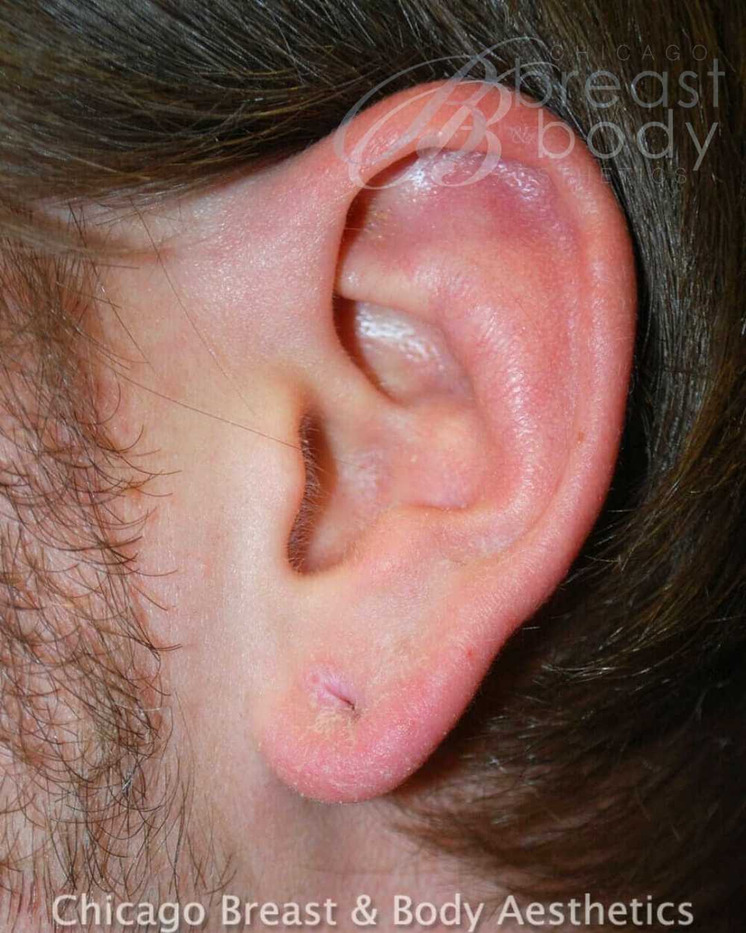 Earlobe Repair Before After Chicago Breast and Body 272