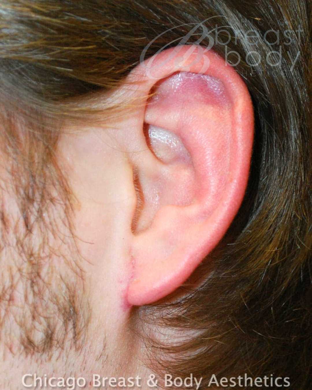 Earlobe Repair Before After Chicago Breast and Body 272