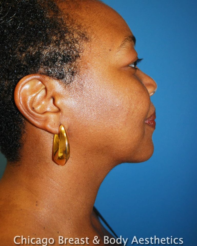 After NeckSculpt neck liposuction photo, case 235, patient of Dr. Anh-Tuan Truong, side profile