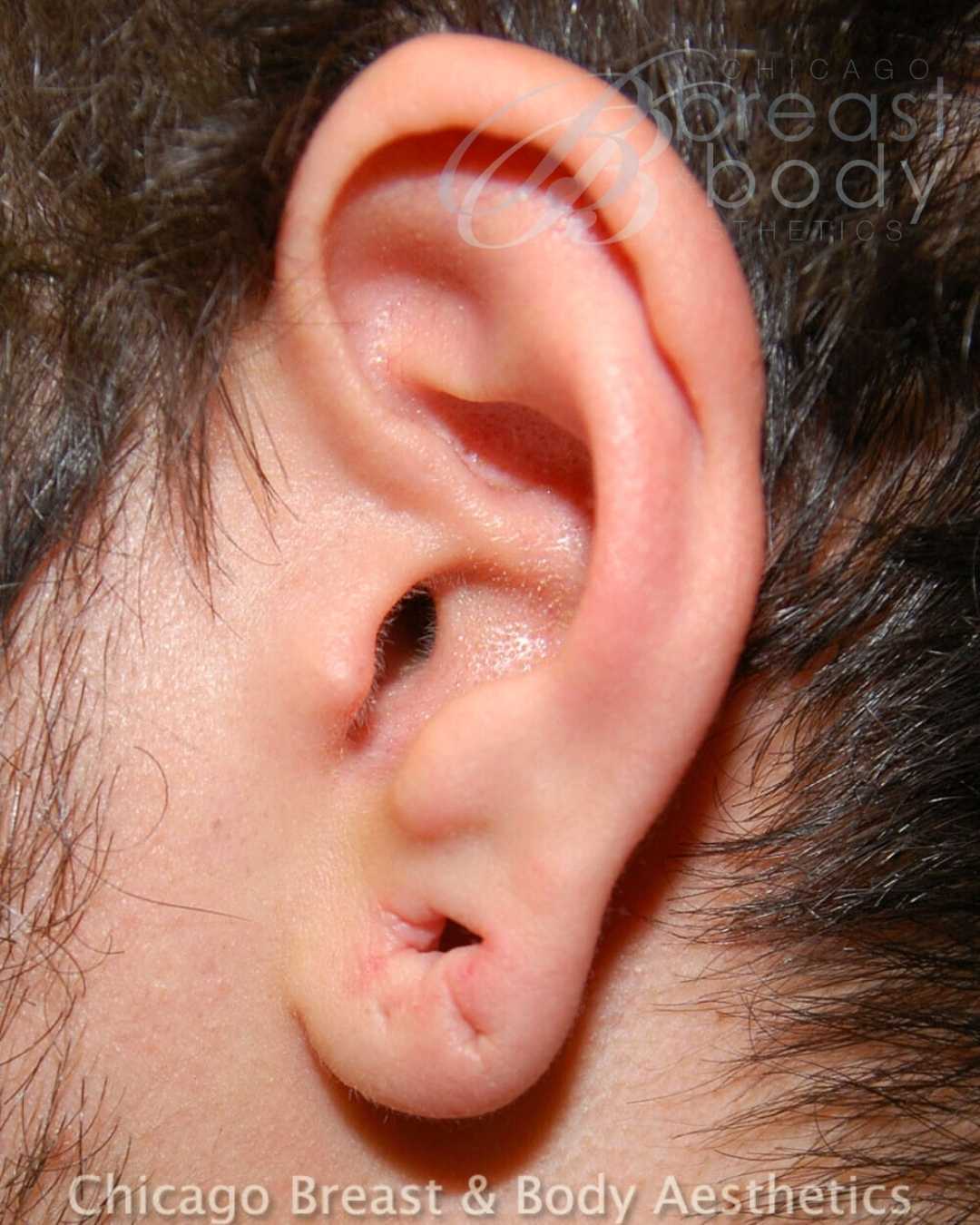 Stretched Earlobe Gauge Repair Before After Chicago Breast and Body 400