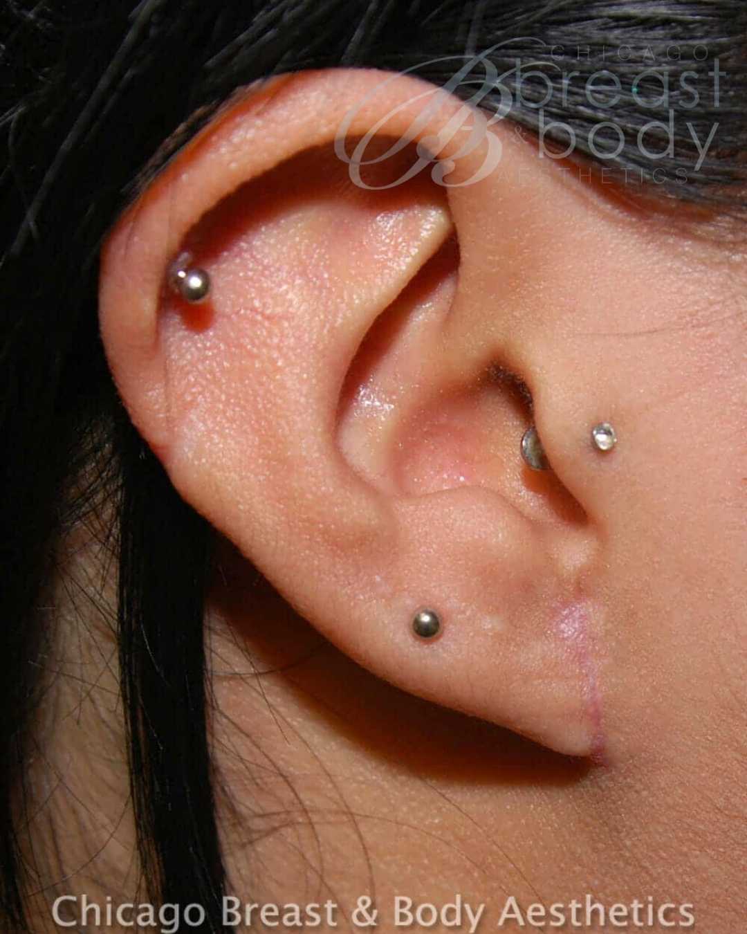 Stretched Earlobe Gauge Repair Before After Chicago Breast and Body 402