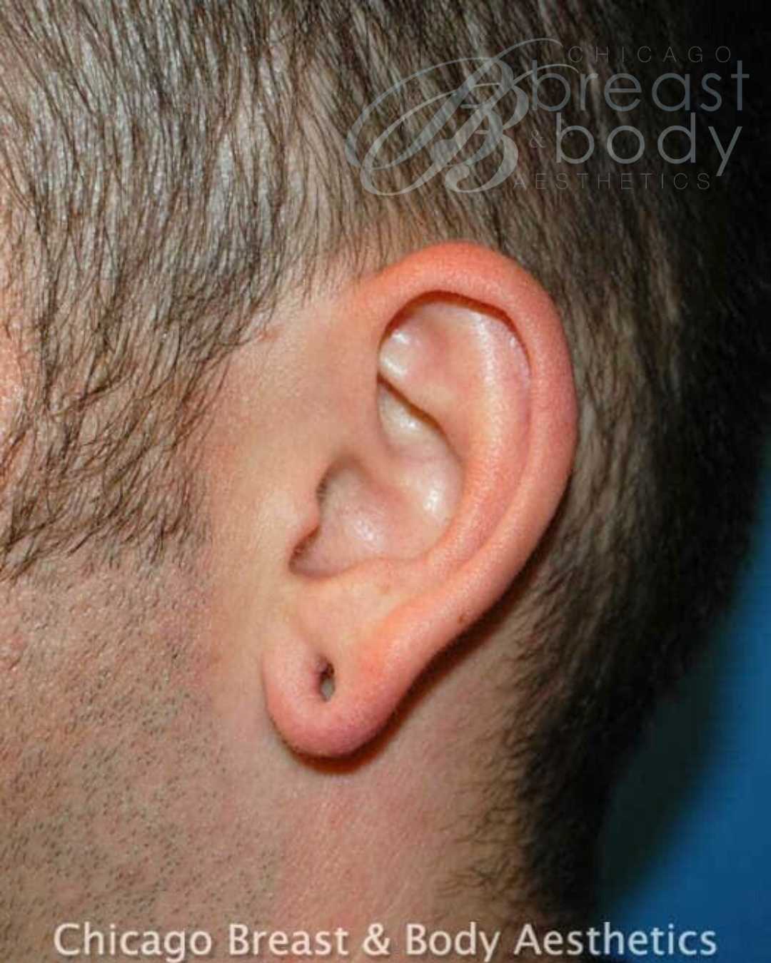 Earlobe Repair before photo 2, case #133, Dr. Anh-Tuan Truong, Chicago Breast & Body