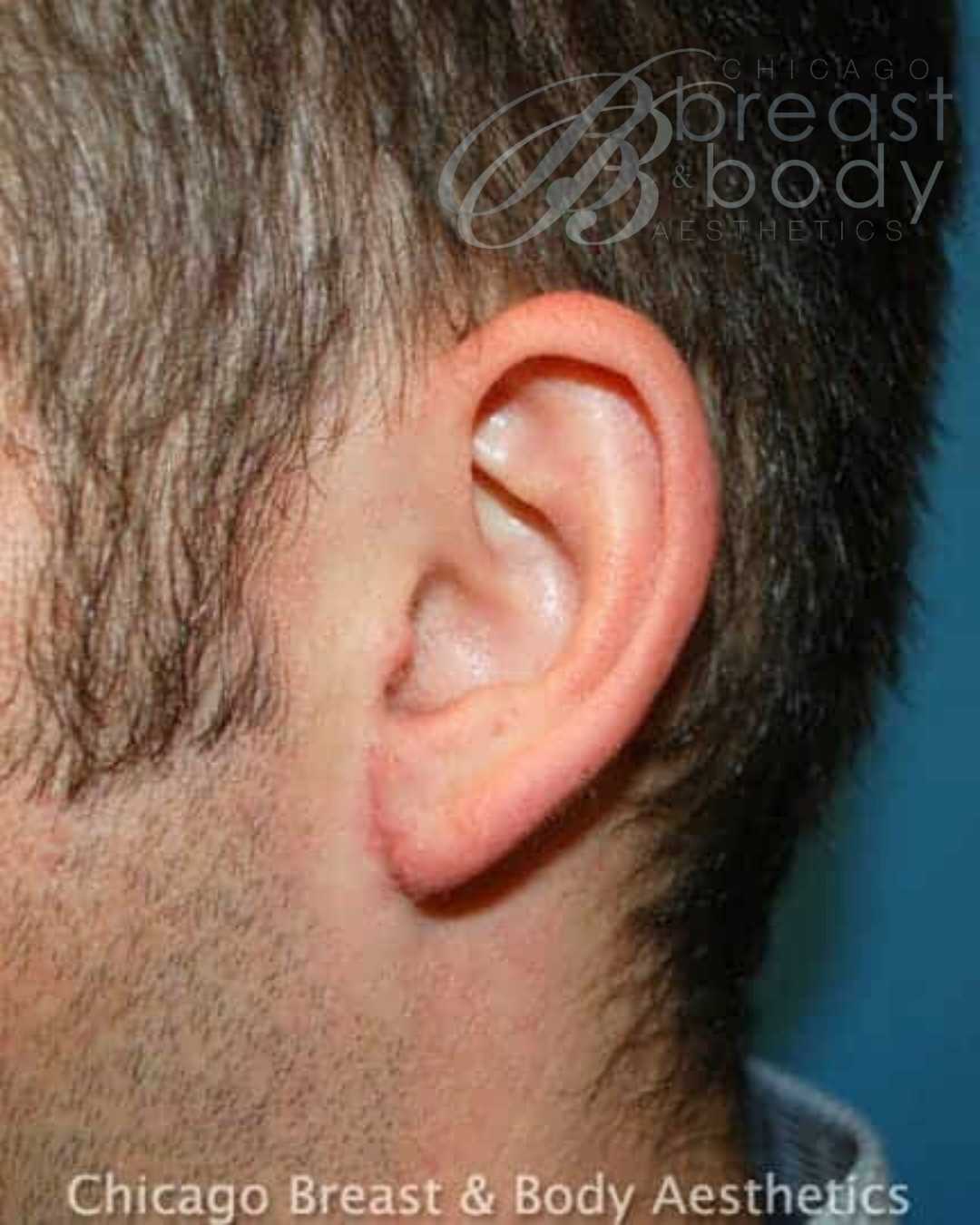 Earlobe Repair after photo 2, case #133, Dr. Anh-Tuan Truong, Chicago Breast & Body