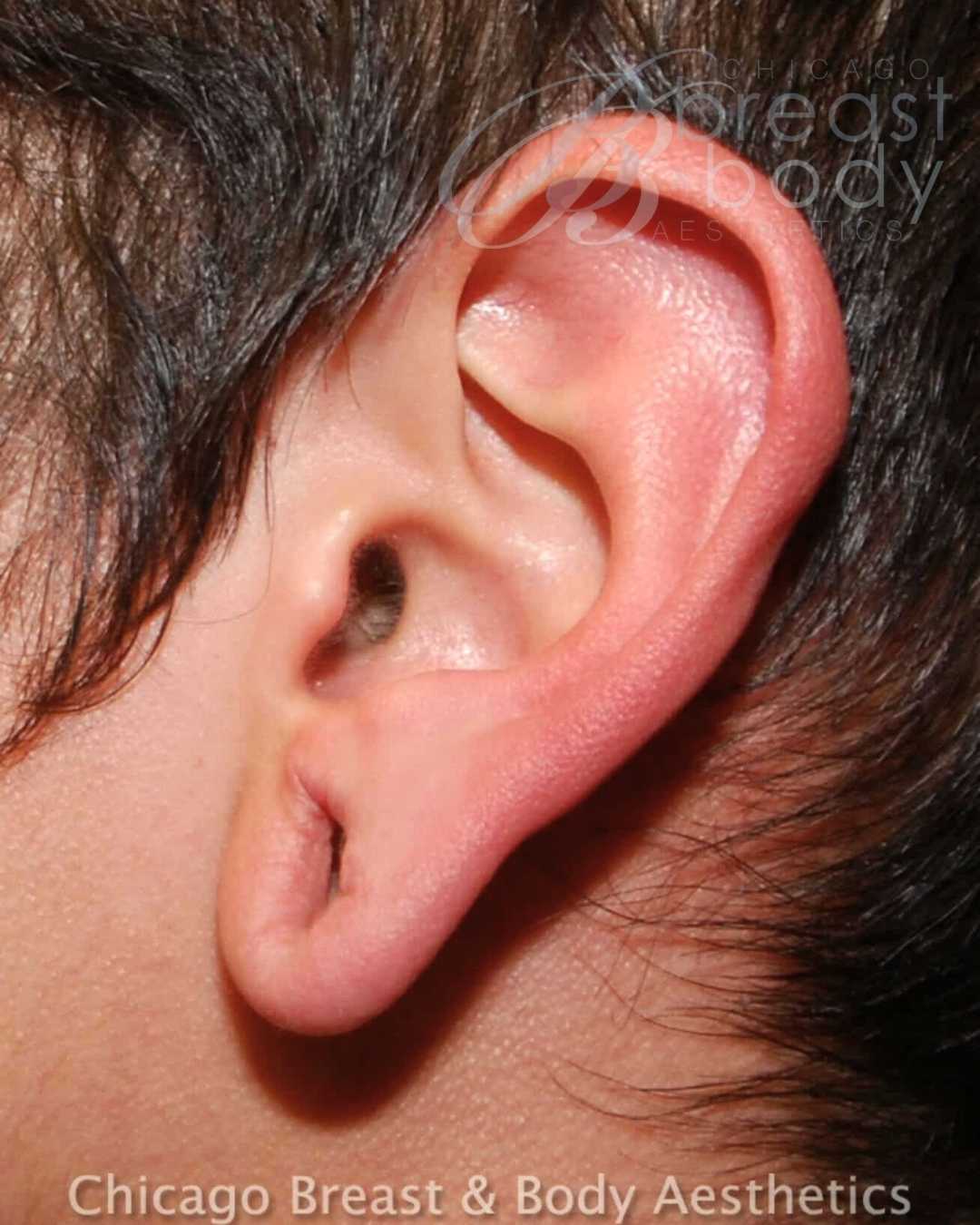 Earlobe Repair before photo 2, case #96, Dr. Anh-Tuan Truong, Chicago Breast & Body
