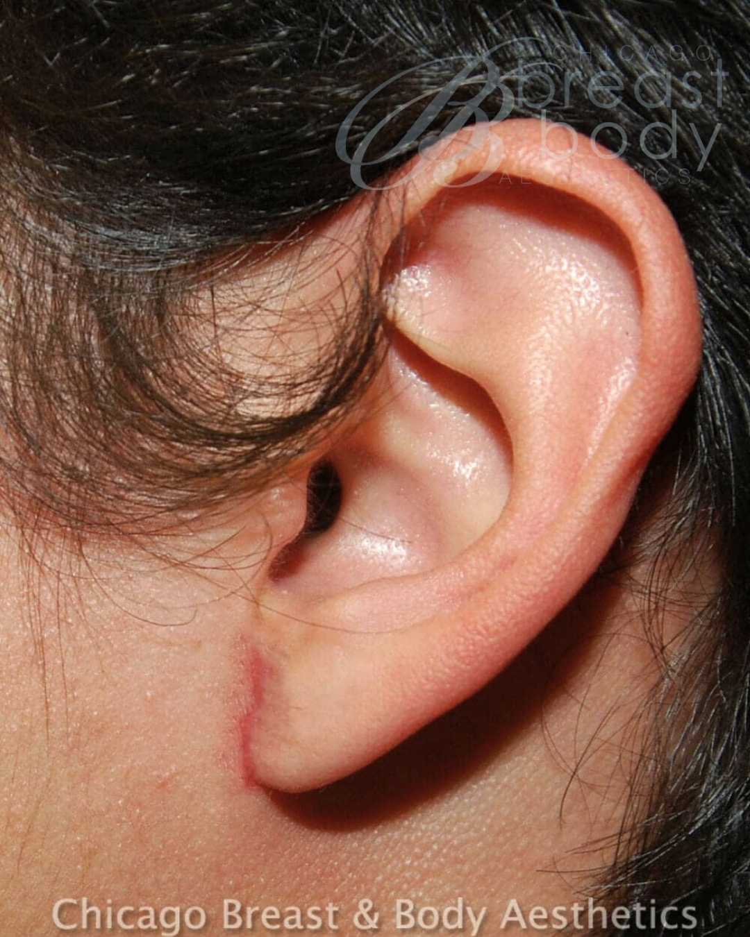 Earlobe Repair after photo 2, case #96, Dr. Anh-Tuan Truong, Chicago Breast & Body