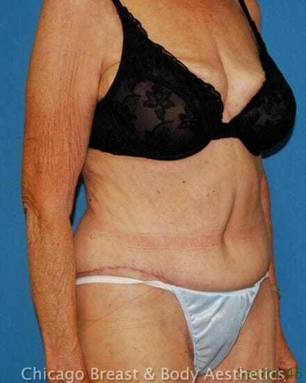 Abdominoplasty (Tummy Tuck) after photo 2, case #22345, Dr. Anh-Tuan Truong, Chicago Breast & Body