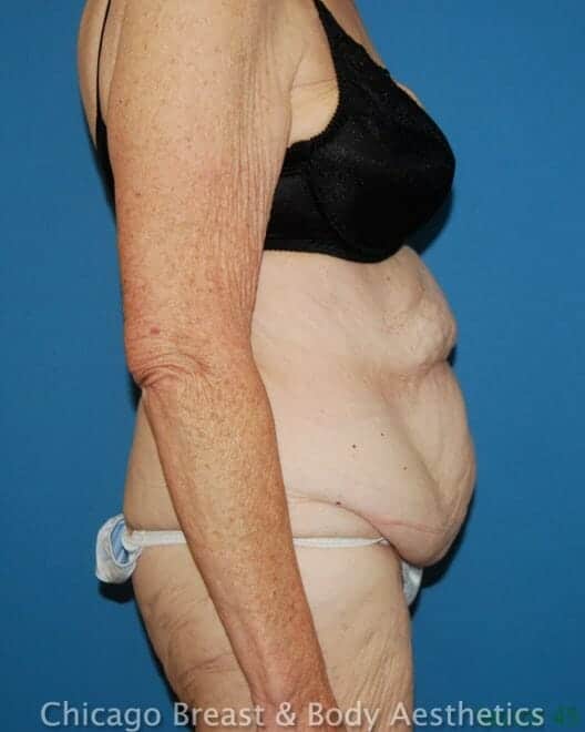Abdominoplasty (Tummy Tuck) before photo 3, case #22345, Dr. Anh-Tuan Truong, Chicago Breast & Body